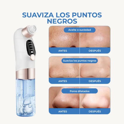 LIMPIADOR FACIAL POR SUCCIÓN | Limpieza profesional desde casa, resultados desde el primer uso.✨